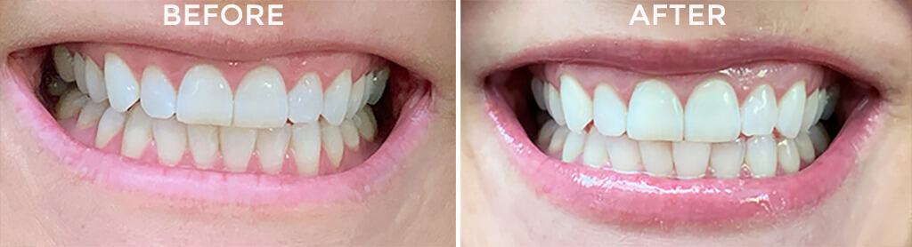 Smile Brilliant teeth whitening review — the results are amazing!